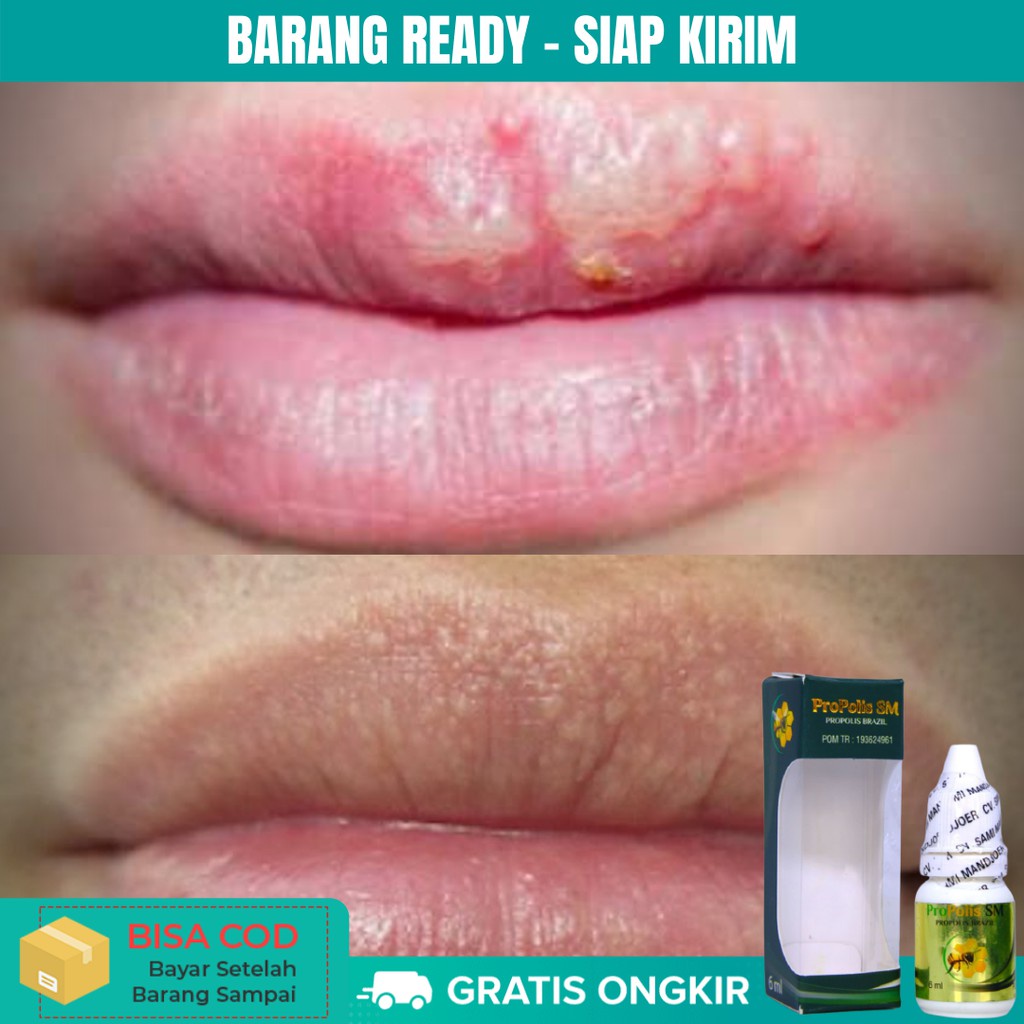 Detail Bintik Bintik Di Bibir Nomer 41