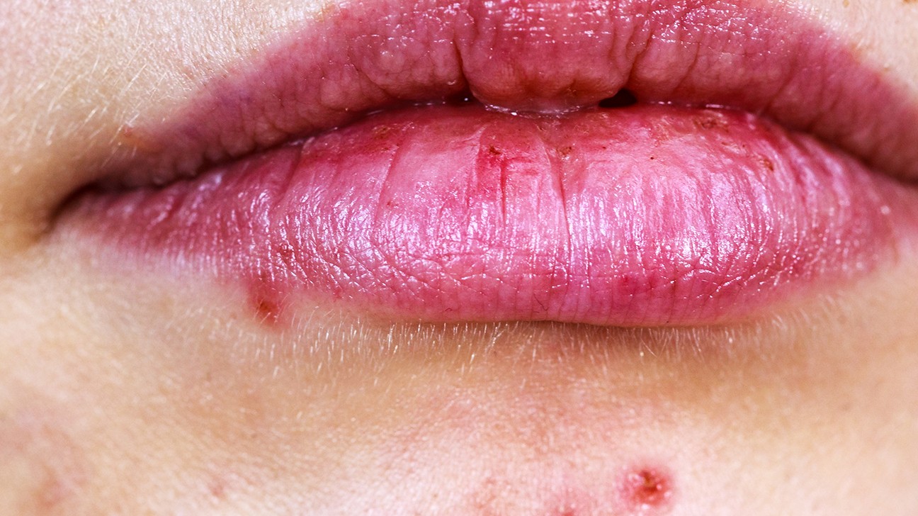 Detail Bintik Merah Di Bibir Nomer 10