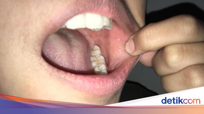 Detail Bintik Merah Di Bibir Nomer 16