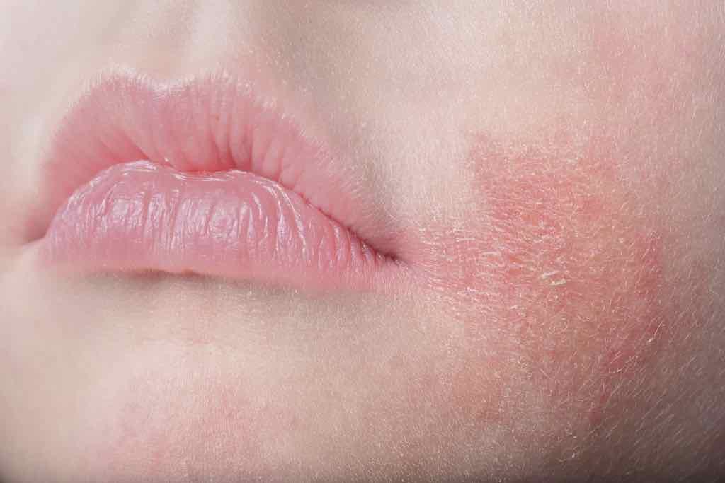 Detail Bintik Merah Di Bibir Nomer 21