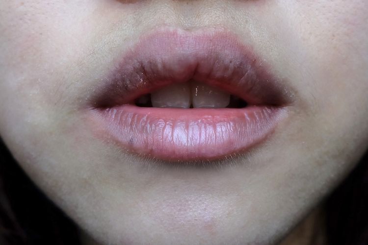 Detail Bintik Merah Di Bibir Nomer 28