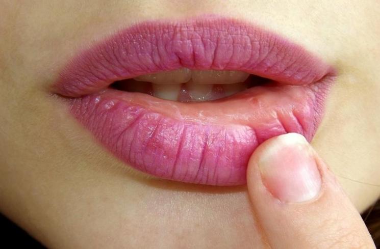 Detail Bintik Merah Di Bibir Nomer 38