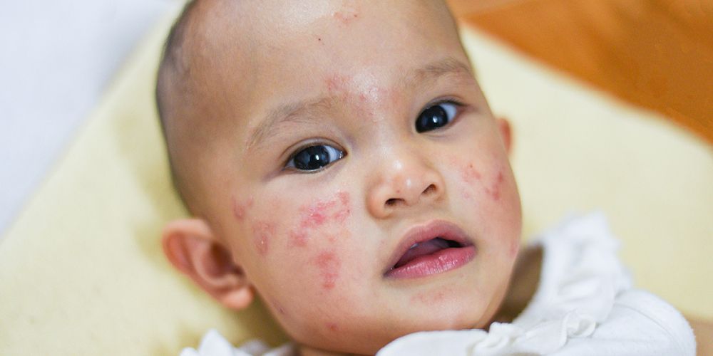 Detail Bintik Merah Pada Leher Bayi Nomer 37