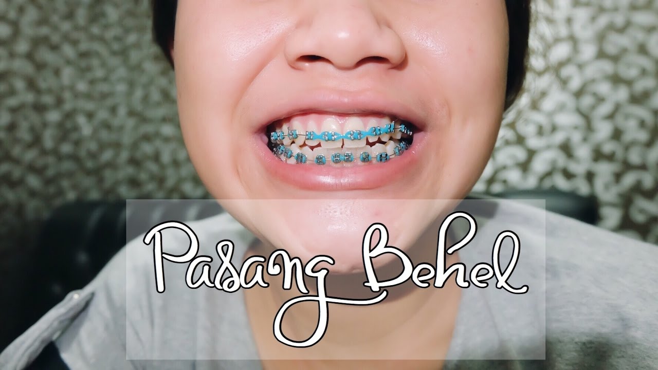 Foto Orang Pake Behel - KibrisPDR