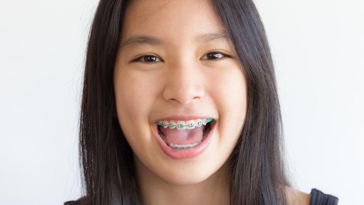 Detail Foto Orang Pake Behel Nomer 11