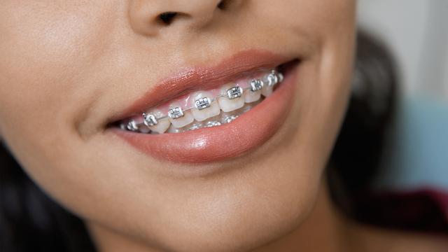 Detail Foto Orang Pake Behel Nomer 12