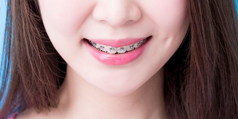 Detail Foto Orang Pake Behel Nomer 13