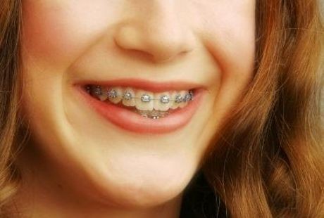 Detail Foto Orang Pake Behel Nomer 14