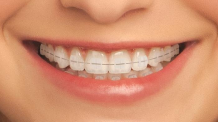 Detail Foto Orang Pake Behel Nomer 15