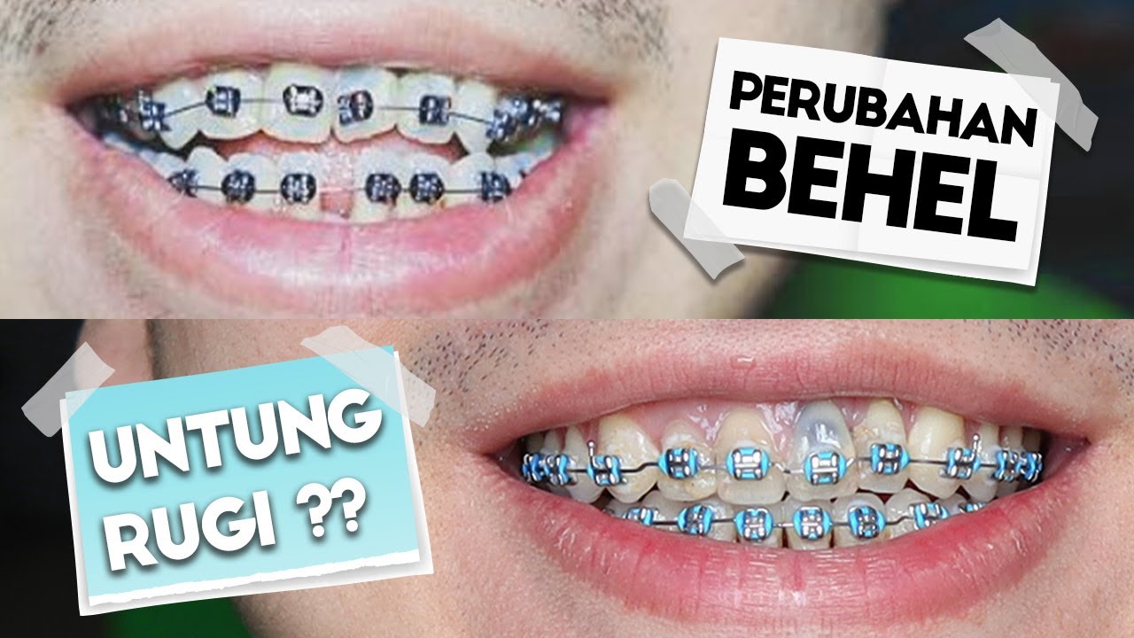 Detail Foto Orang Pake Behel Nomer 16