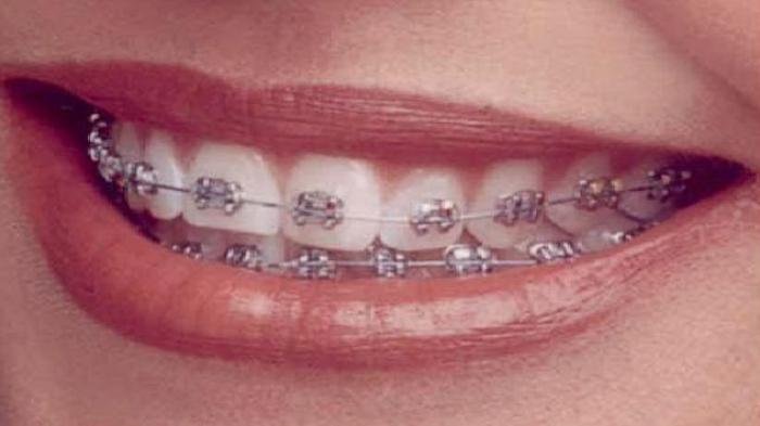 Detail Foto Orang Pake Behel Nomer 17