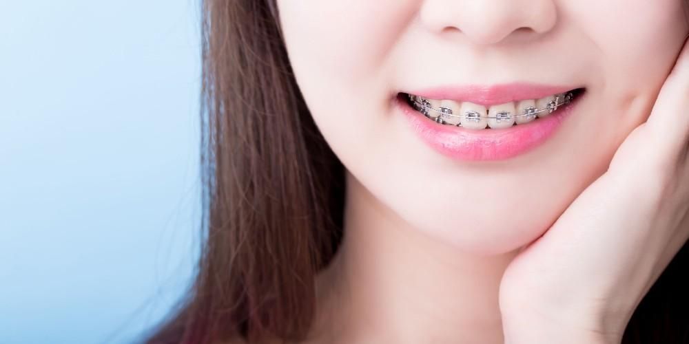 Detail Foto Orang Pake Behel Nomer 18