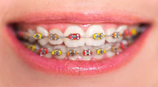 Detail Foto Orang Pake Behel Nomer 19