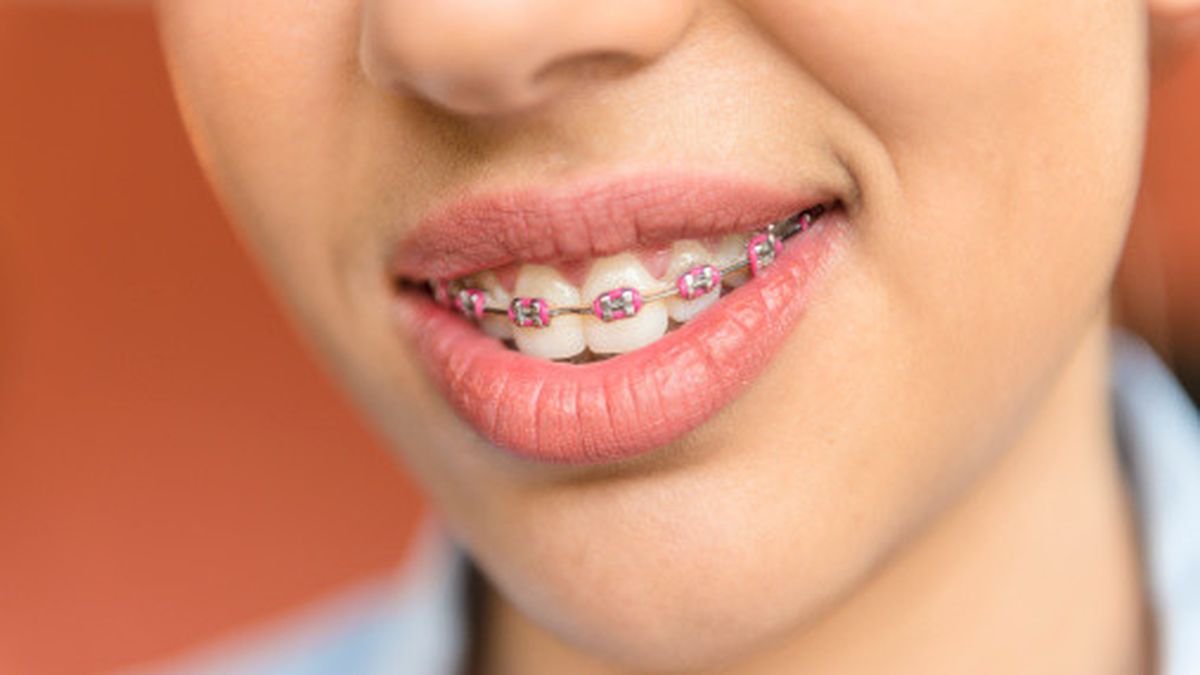 Detail Foto Orang Pake Behel Nomer 3