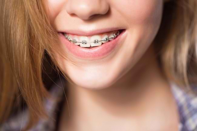 Detail Foto Orang Pake Behel Nomer 20