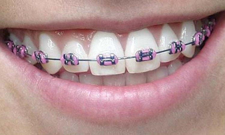Detail Foto Orang Pake Behel Nomer 22