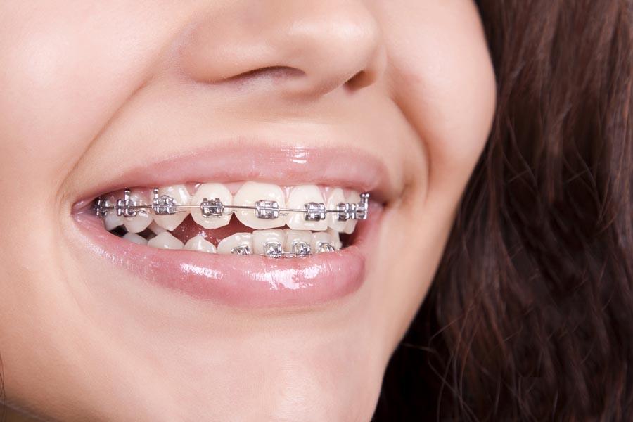 Detail Foto Orang Pake Behel Nomer 23