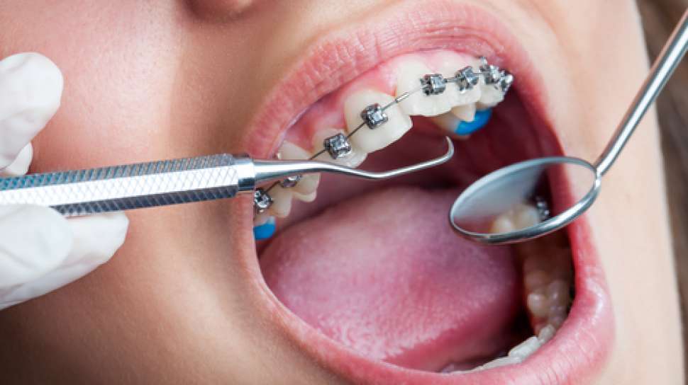 Detail Foto Orang Pake Behel Nomer 24