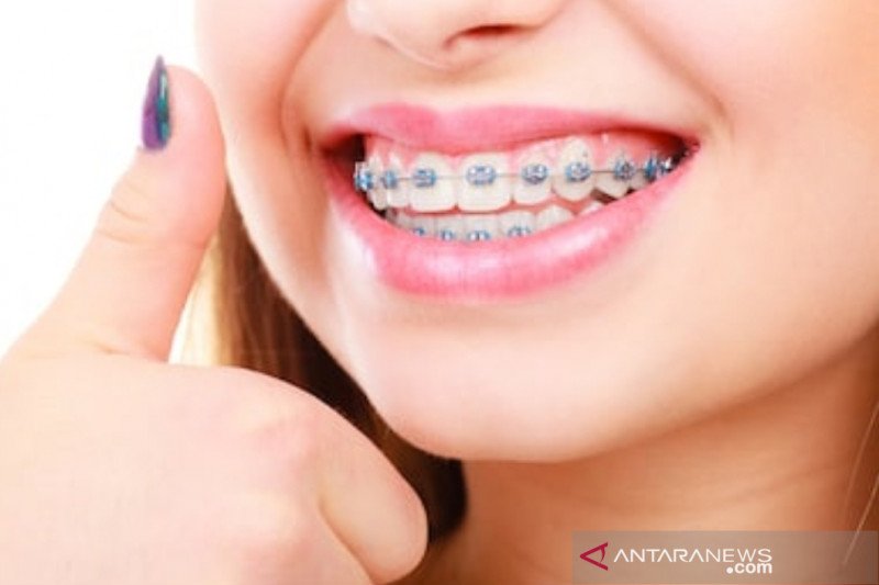 Detail Foto Orang Pake Behel Nomer 27