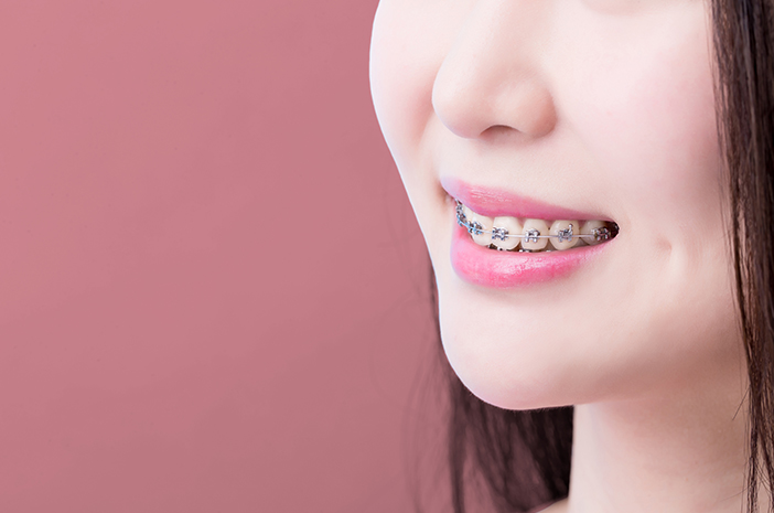 Detail Foto Orang Pake Behel Nomer 4
