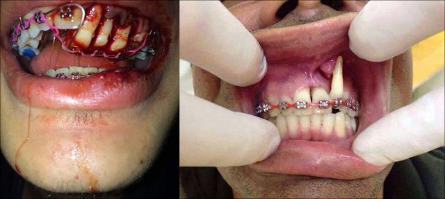 Detail Foto Orang Pake Behel Nomer 29