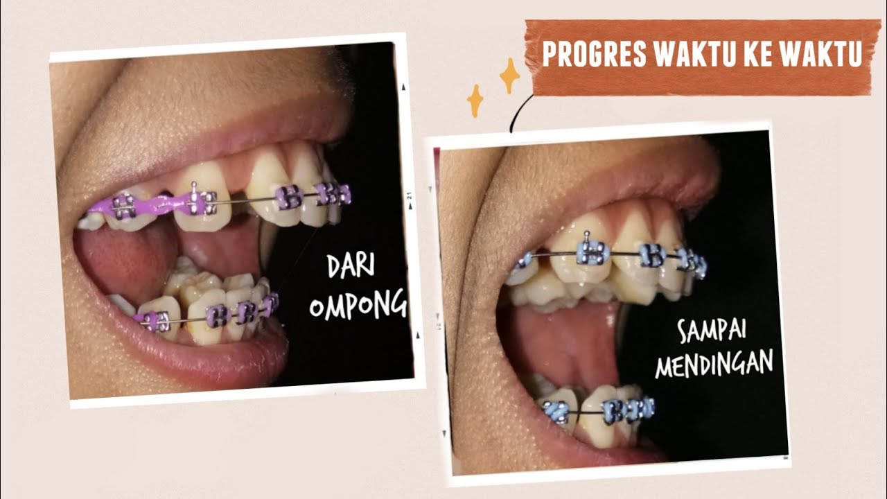 Detail Foto Orang Pake Behel Nomer 30