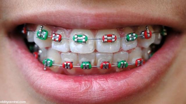 Detail Foto Orang Pake Behel Nomer 31