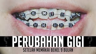 Detail Foto Orang Pake Behel Nomer 32