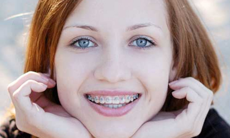 Detail Foto Orang Pake Behel Nomer 33