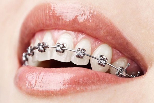 Detail Foto Orang Pake Behel Nomer 34