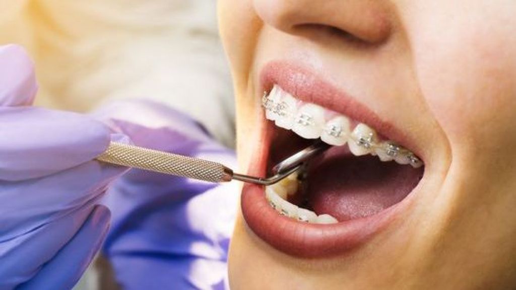 Detail Foto Orang Pake Behel Nomer 35