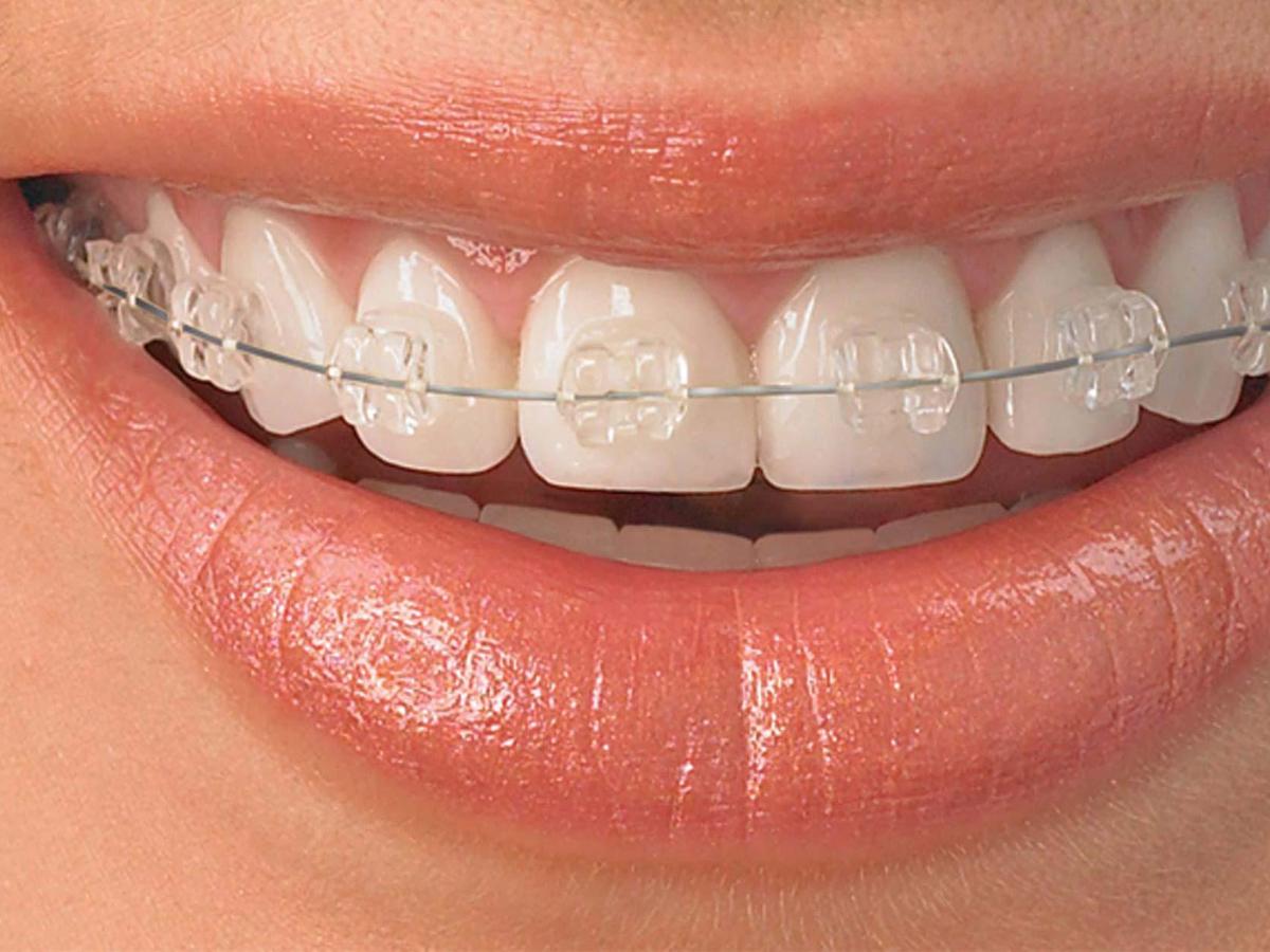 Detail Foto Orang Pake Behel Nomer 36