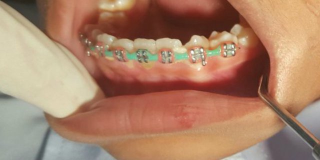 Detail Foto Orang Pake Behel Nomer 38