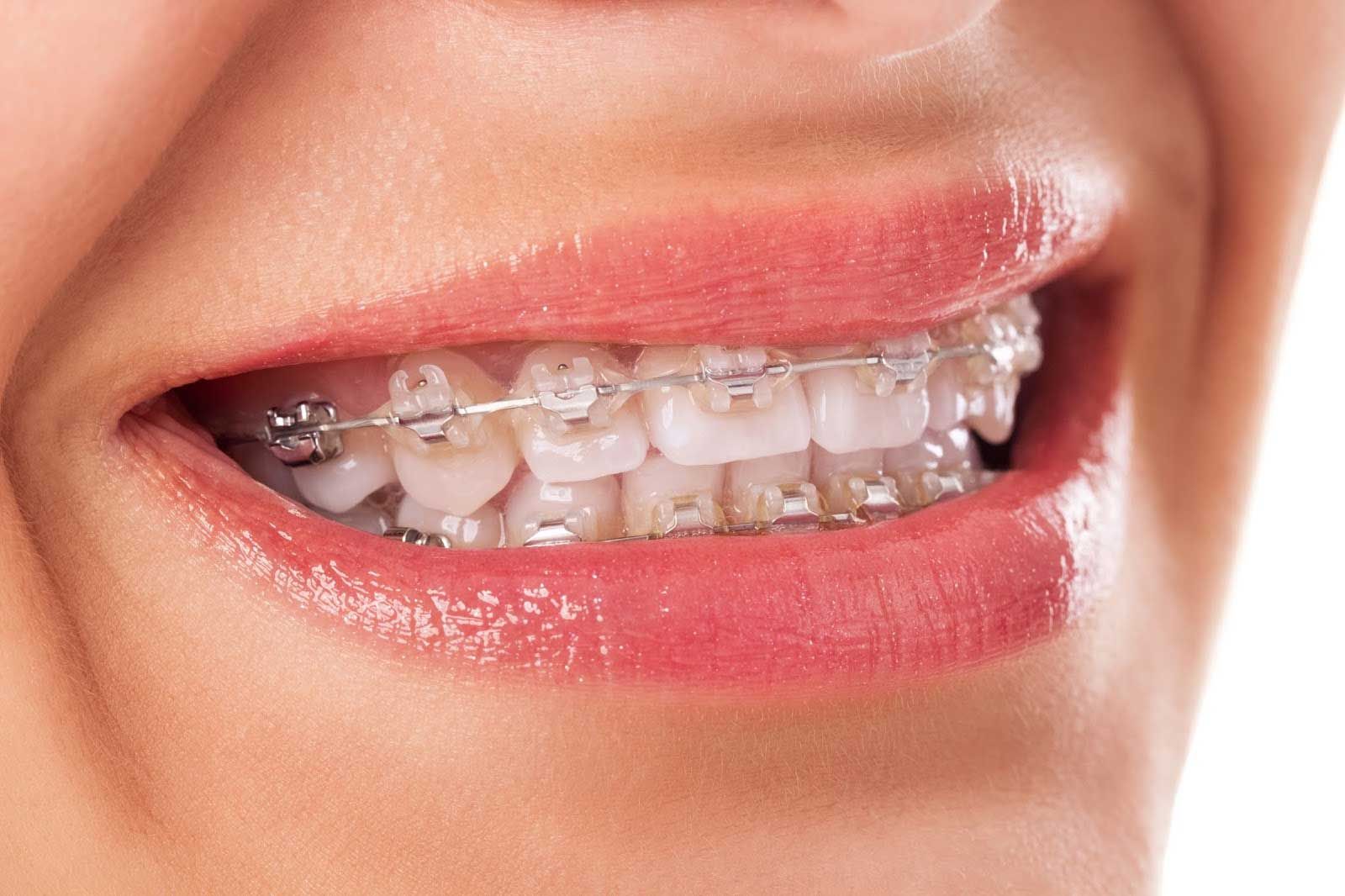 Detail Foto Orang Pake Behel Nomer 5