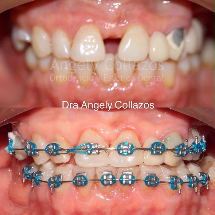 Detail Foto Orang Pake Behel Nomer 44