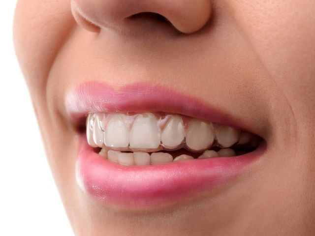 Detail Foto Orang Pake Behel Nomer 45