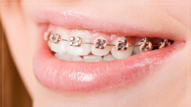 Detail Foto Orang Pake Behel Nomer 47