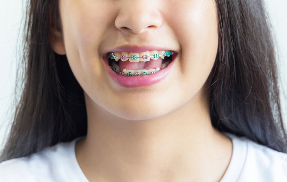 Detail Foto Orang Pake Behel Nomer 6