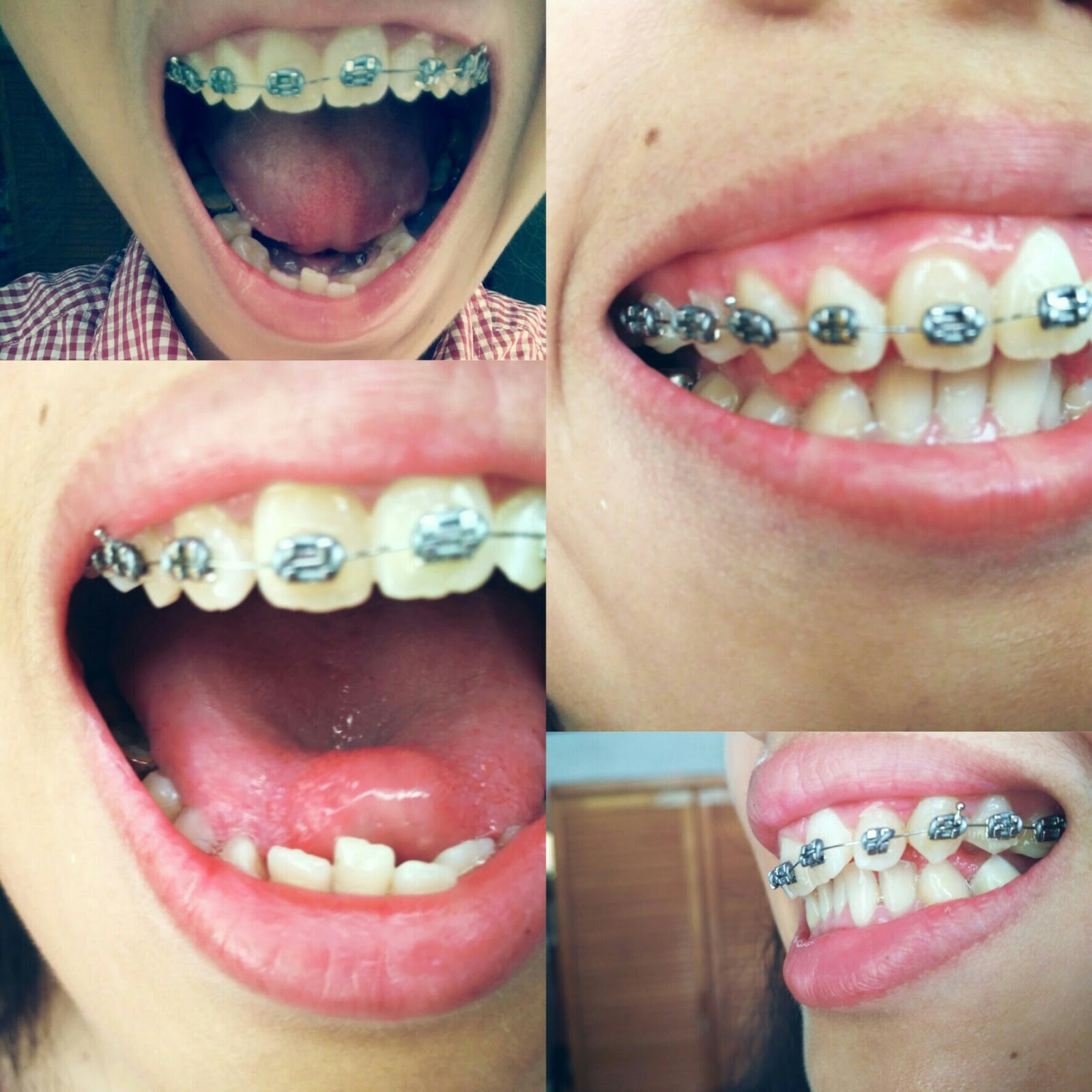Detail Foto Orang Pake Behel Nomer 48