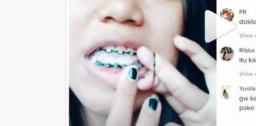 Detail Foto Orang Pake Behel Nomer 51