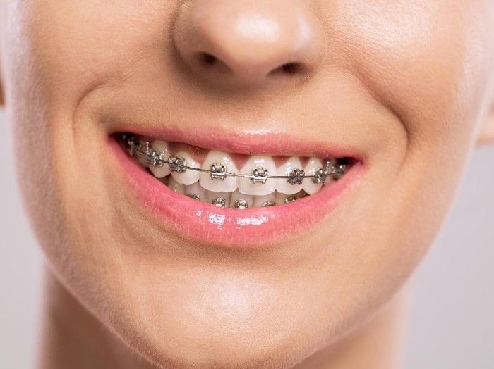 Detail Foto Orang Pake Behel Nomer 54