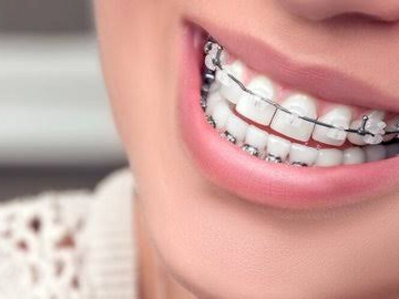 Detail Foto Orang Pake Behel Nomer 55