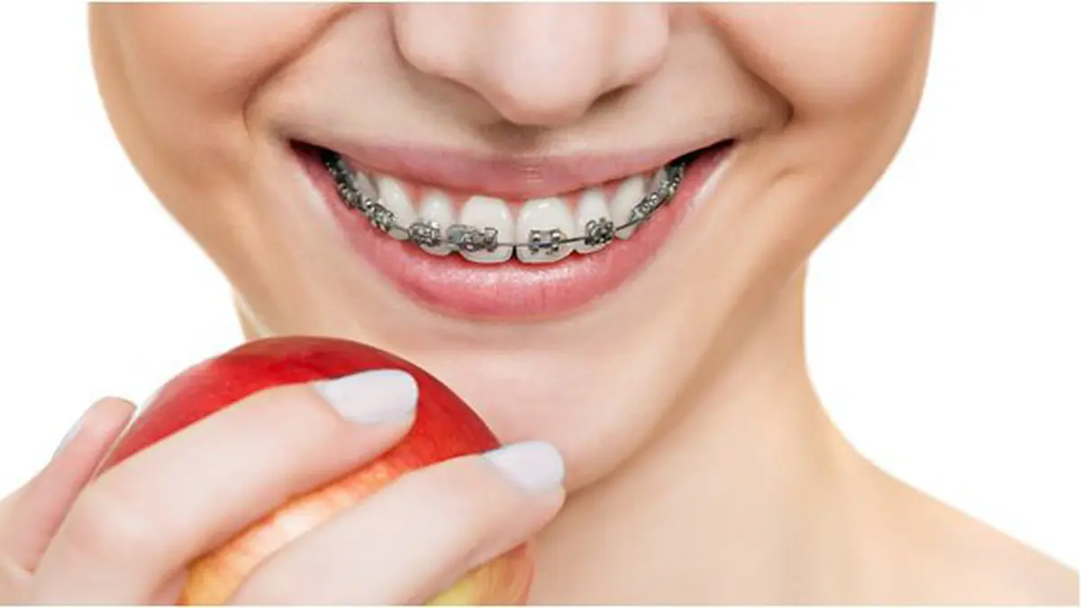 Detail Foto Orang Pake Behel Nomer 56
