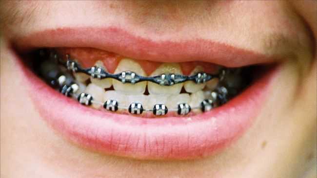 Detail Foto Orang Pake Behel Nomer 8