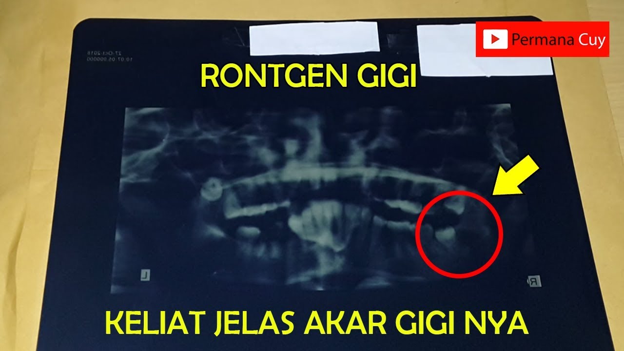 Detail Foto Rontgen Gigi Nomer 53