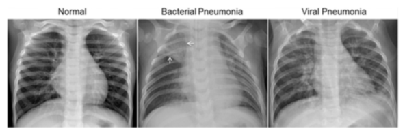 Detail Foto Rontgen Pneumonia Nomer 2