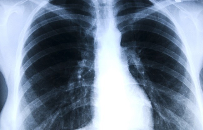 Detail Foto Rontgen Pneumonia Nomer 13