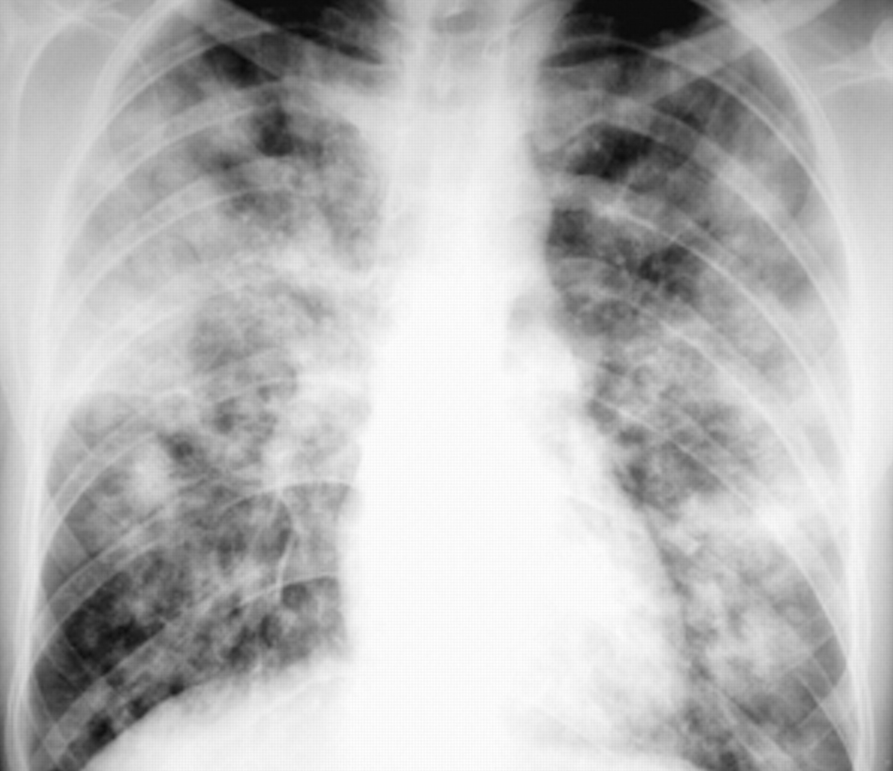 Detail Foto Rontgen Pneumonia Nomer 23