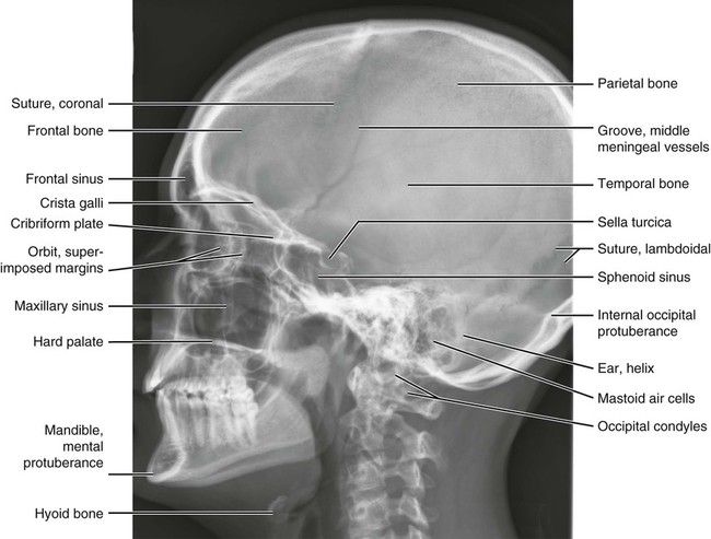Detail Foto Skull Radiologi Nomer 13