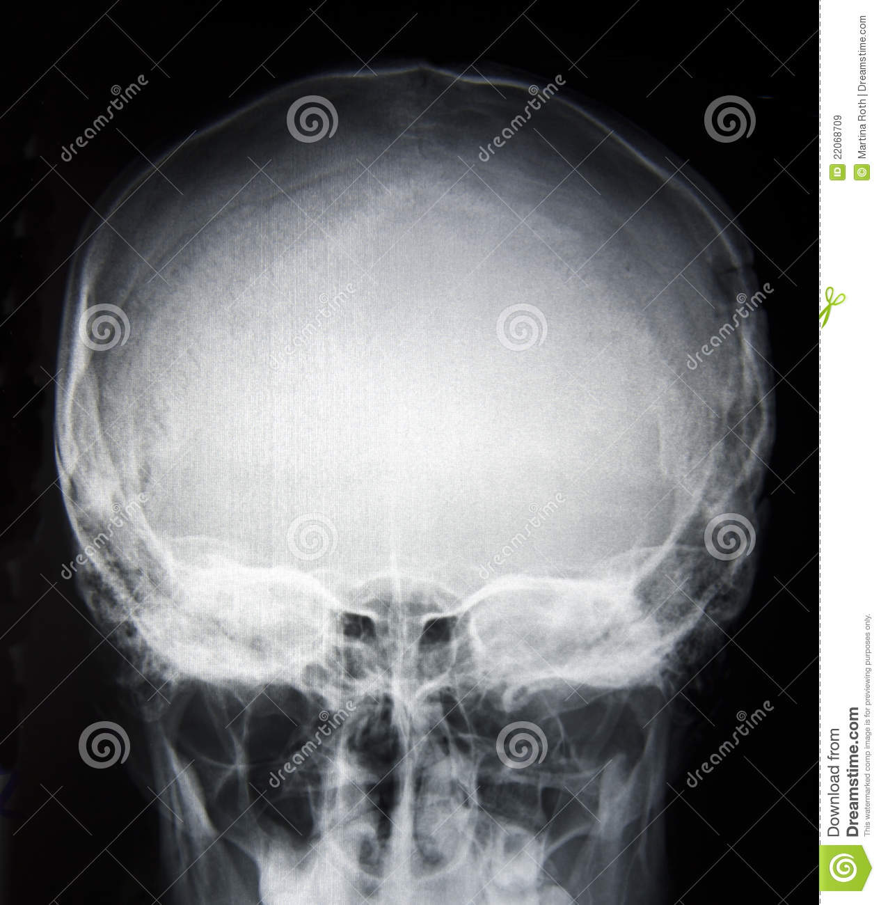 Detail Foto Skull Radiologi Nomer 17